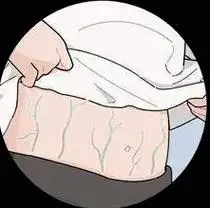 如果腹部有青筋且比较暴突,即俗话说的"青筋过肚",这已经是比较严重的