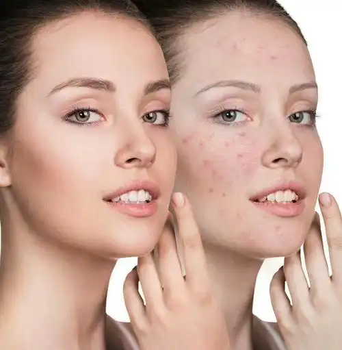 痘痘灭不净,春风吹又生