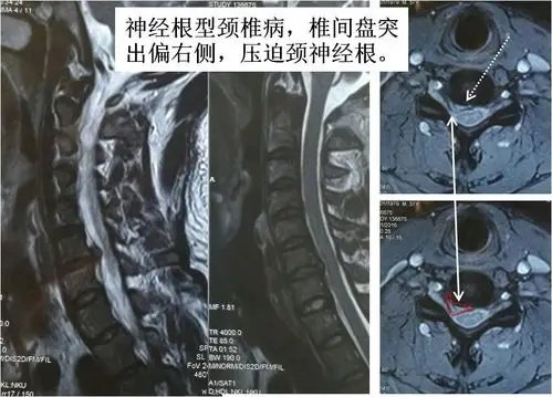 ① 神经根型颈椎病的患者,症状主要表现为一侧颈部和胳膊疼痛,上举