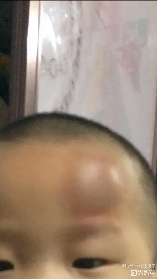 前脑门在哪里(前脑门儿疼是什么原因?