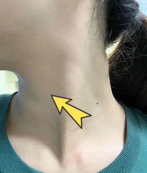 位于胸锁乳突肌内侧缘,环状软骨中线或环状软骨下方中线.2.