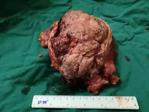 膀胱癌是人体常见的恶性肿瘤,近年来佛山市中医院泌尿外科(外三科)