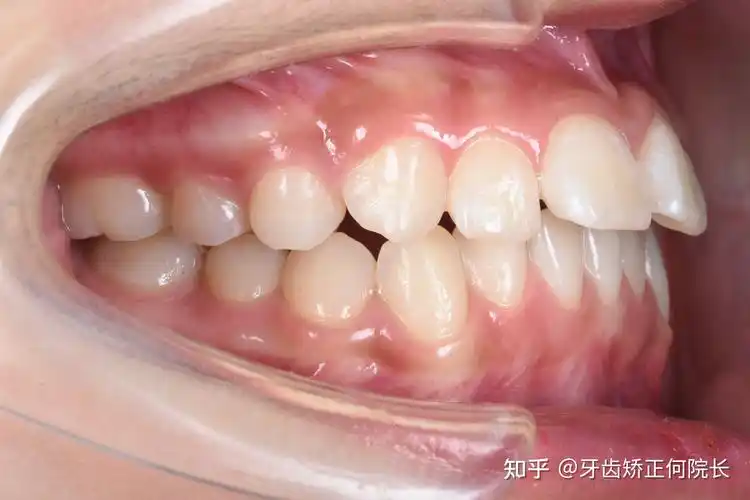 上颌前突下巴后缩几岁矫正好