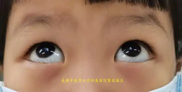 莫亚主任医师说儿童下睑倒睫