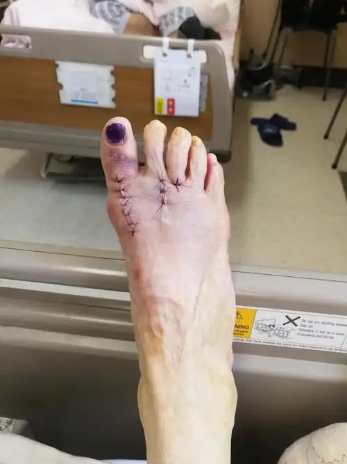 中年女性,拇外翻明显,通过软组织松解及截骨,力线得到纠正,矫正满意术