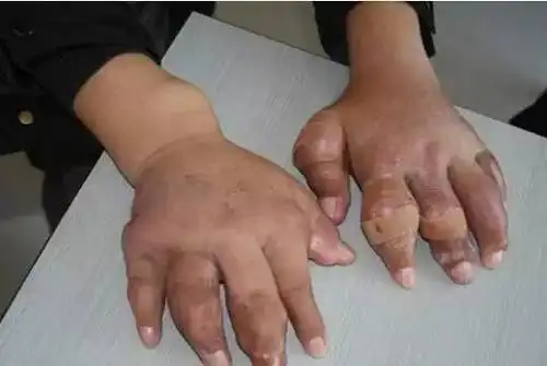 痛风不同时期的症状表现