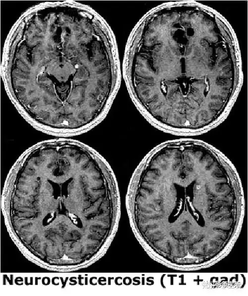 脑囊虫病的诊断与鉴别
