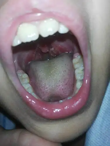 这是怎么回事呀,第一次看到儿子喉咙上有白色东西