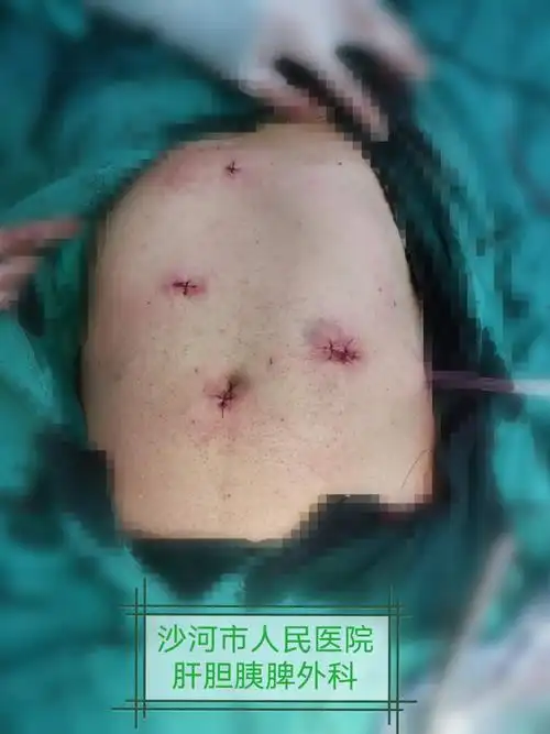 我院肝胆外科成功为一例原发性血小板减少症患者施行腹腔镜脾切除术