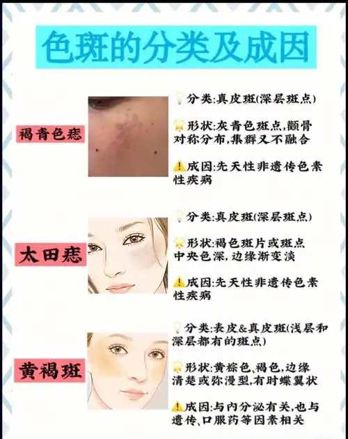 1雀斑2晒斑3老年斑4褐青色痣5太田痣6黄褐斑看图,你是什么类型的呢?