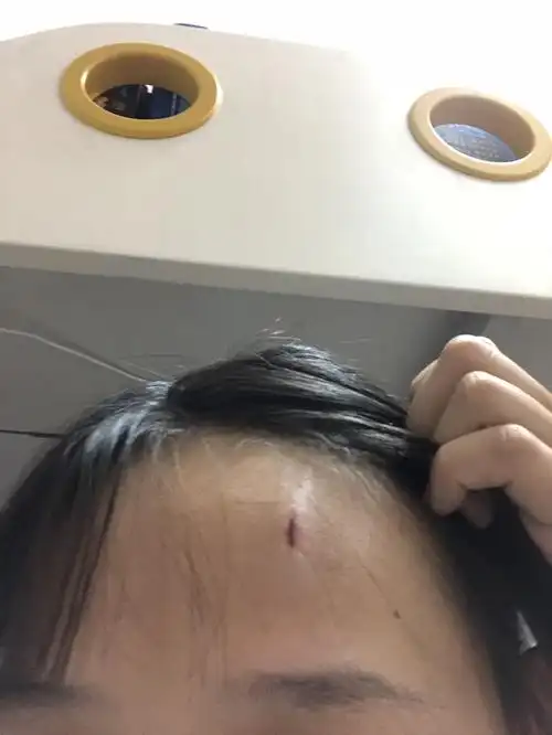 头很痛,应该怎么办?需要消毒吗?用什么消毒,怎么才可以不