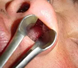 究竟什么是鼻息肉