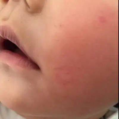 宝宝嘴巴右边这块类似癣一样的是什麼呢?