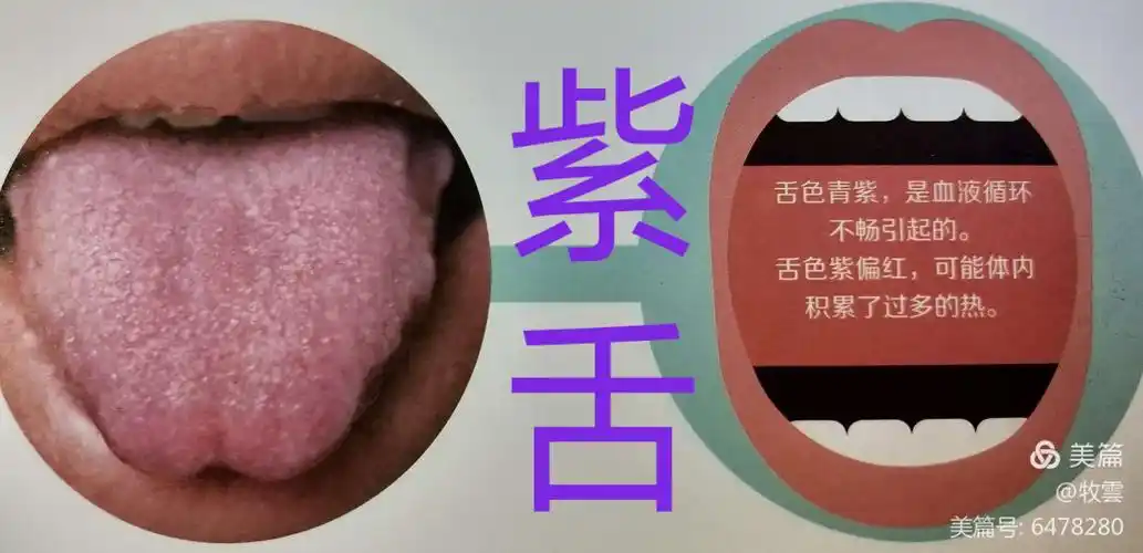 紫舌——血液循环不畅