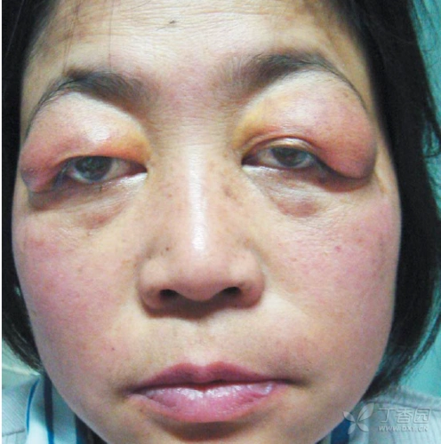 原发性干燥综合症患者的眼睑肿胀一例