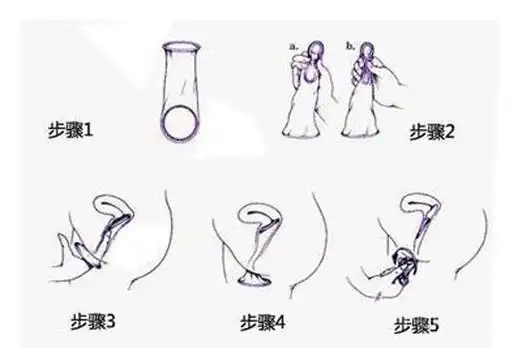 女用避孕套的使用方法
