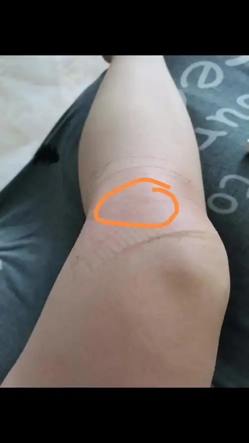 膝盖下面内侧这里好疼?