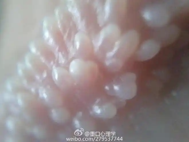 珍珠疹(hirsuties papillaris genitalis),又称为阴茎珍珠样丘疹病