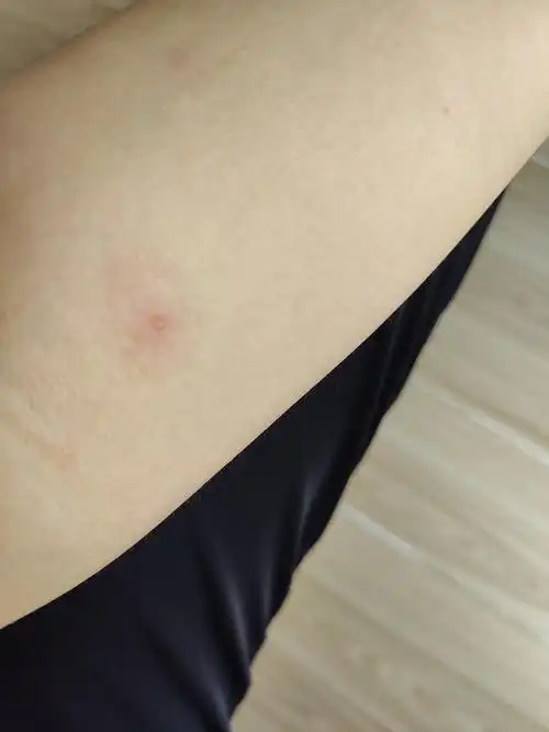 (更新)这是带状疱疹吗?突然觉得会不会传染啊 我们店有三个.