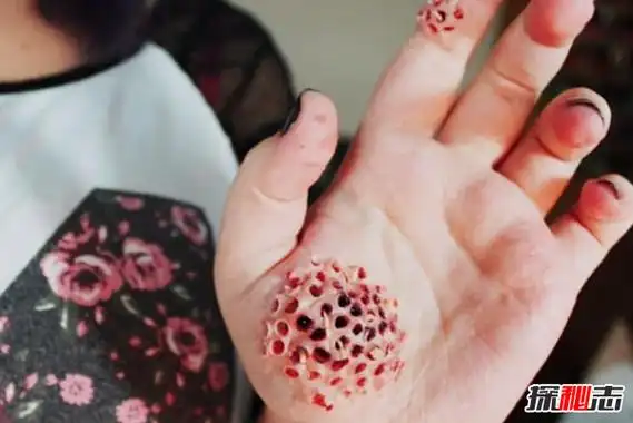 1,密集物体恐惧症