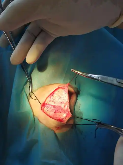 腋臭复发后根治并祛除瘢痕