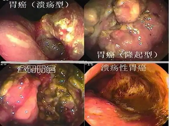 年轻肠胃癌有症状么(年轻人肠胃癌)