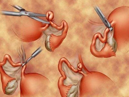 结扎是什么意思对男生有危害吗输卵管结扎是什么意思