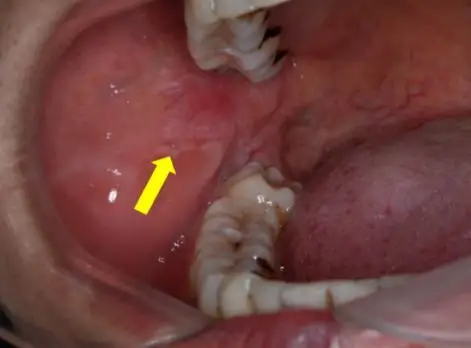 疫情时期跨过内心的拐点为您的口腔黏膜保驾护航