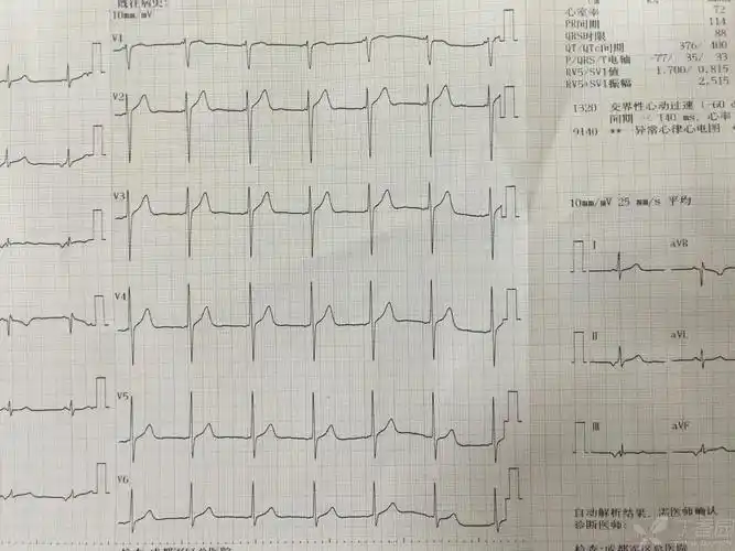 心悸,心动过速,心电图为交界性心动过速,pr间期缩短 [病例帖]