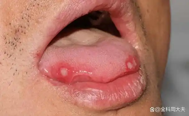 舌头起泡以为溃疡,没想到是舌癌!医生:与这个几个习惯分不开
