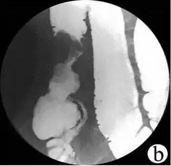 结肠腔内可见一充盈缺损影,呈息肉状突入肠腔,基底宽,局部粘膜皱襞