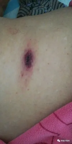 梅州一阿婆被这种虫咬伤,以为感冒…近期高发!