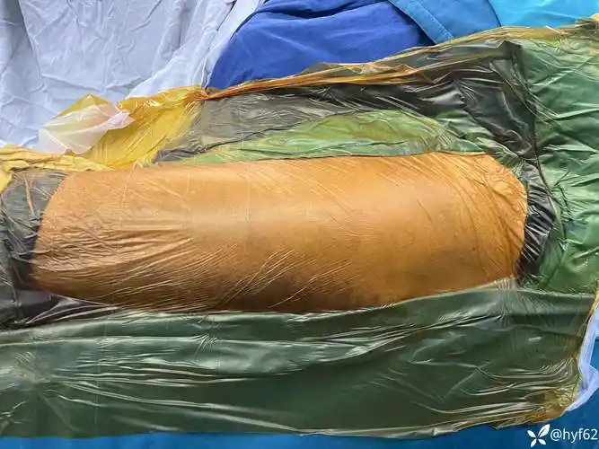 97岁小粗隆完整大粗隆游离股骨颈基底嵌插型粗隆间骨折如何做到满意