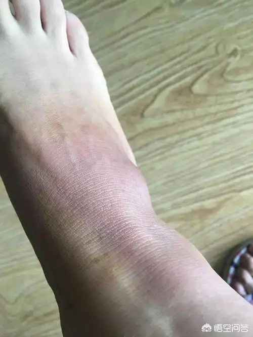 头条问答 - 打球崴脚怎么办?(15个回答)