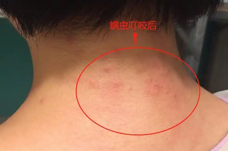 小孩被螨虫咬后图片