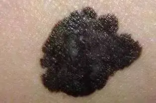 如某处皮肤颜色变深,或者原先皮肤上的黑痣,黑色斑快等发生改变,颈部