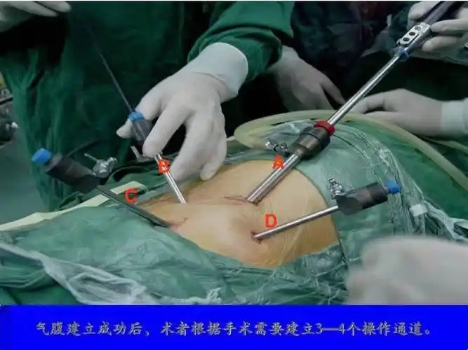 小镜子大世界之腹腔镜手术_进行_子宫_时间