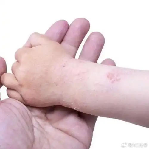 冬天也会长痱子90的家长会误判预防护理一文说清让娃少遭罪