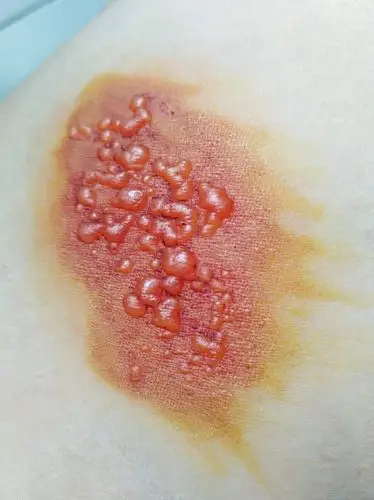 请问这是水泡什么?腿上无缘无故长的?