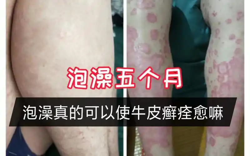 我每天泡澡和运动牛皮癣到底能不能治好