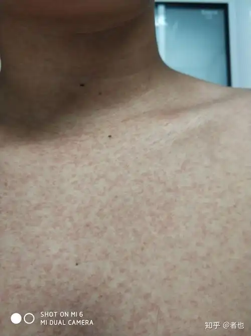 病毒疹病状是什么样什么样子才算是痊愈