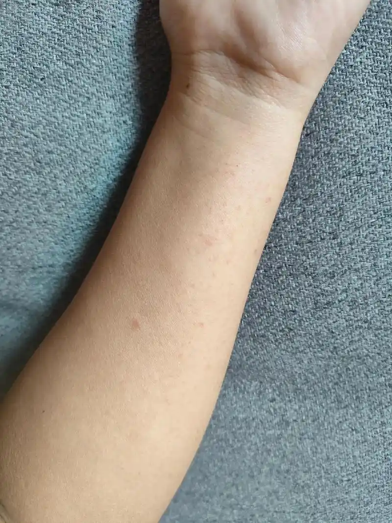 八月末得了这个过敏性紫癜(血管炎)!本以为发现早,检查也没大碍