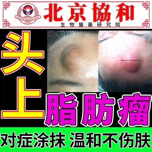头部额头脂肪瘤专用粉瘤肉留去i除膏神器消i除硬块皮下囊肿可搭配特效