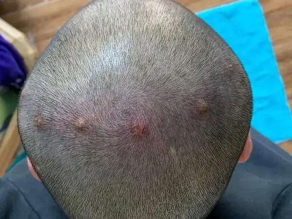 头上长了这个东西,好几个医生都说是毛囊炎,用药一直没好过,求大神