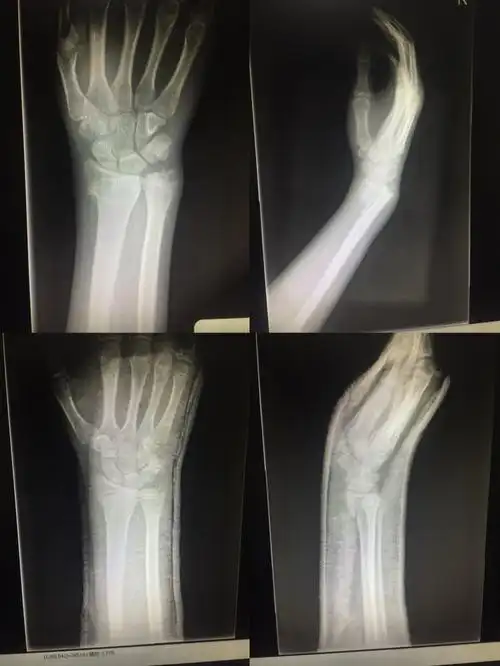 其它 南京邦德骨科医院创伤九病区 写美篇桡骨远端史密斯骨折,手法