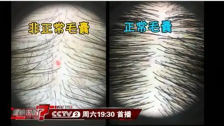 谢顶的人涂抹姜汁可以生发医生当心加速毛囊老化