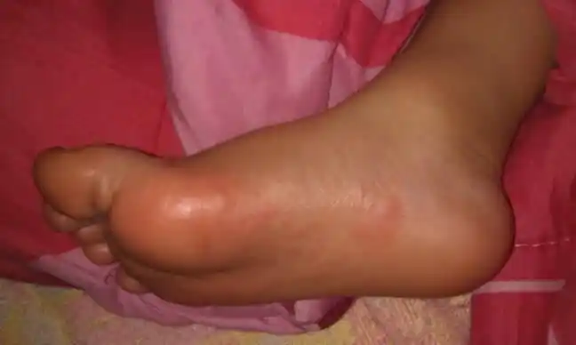 有没有治脚气的土方法啊?