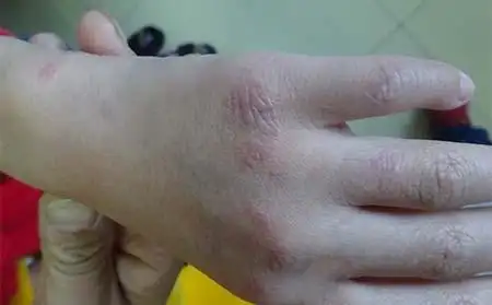 银屑病的症状和图片_银屑病求医网