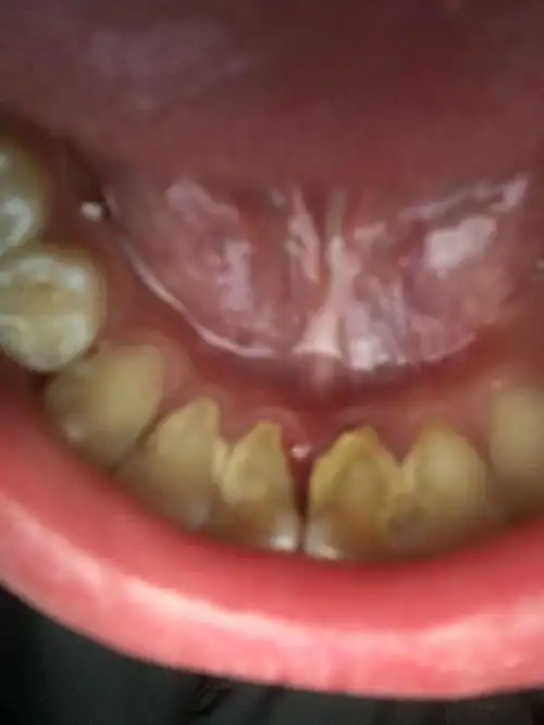 牙齿掉了一小块