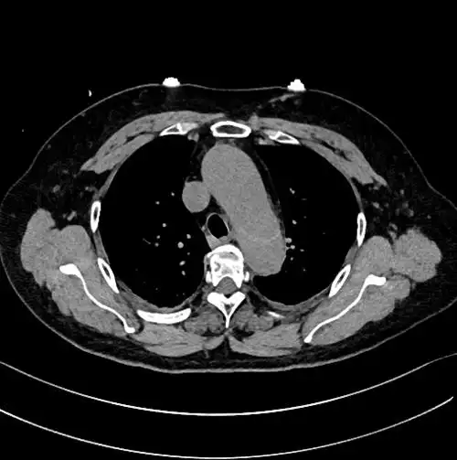 经典图谱ct平扫诊断主动脉夹层